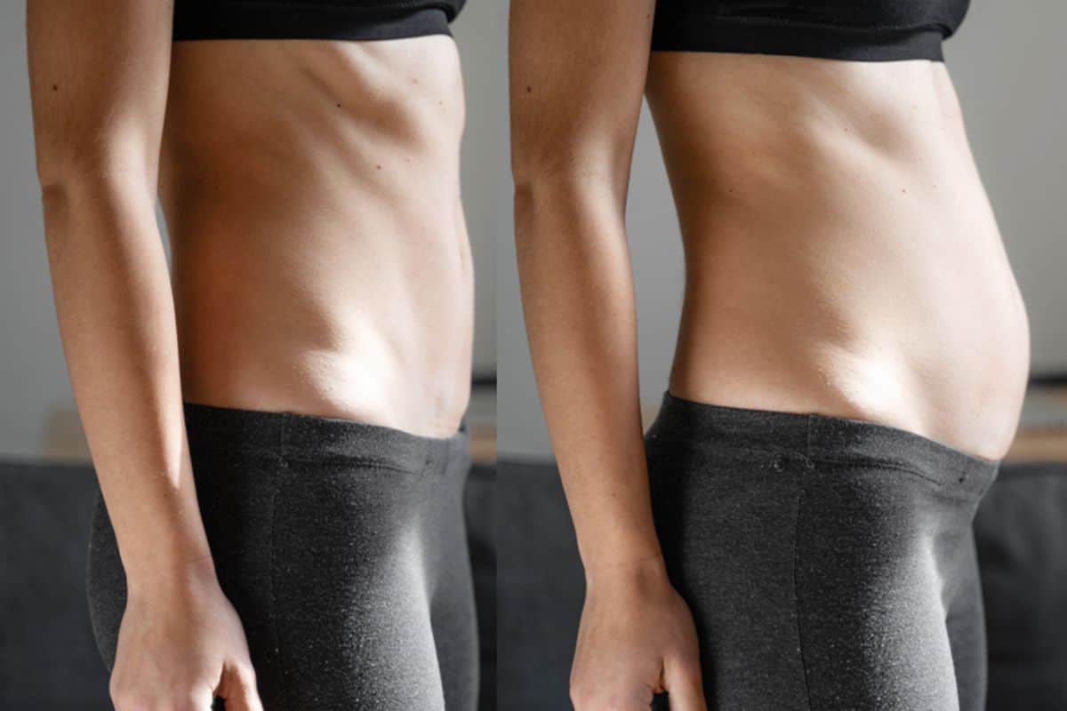 How long does diastasis recti take to improve East Grinstead?