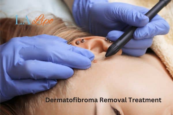 Dermatofibroma Removal Treatment East Grinstead