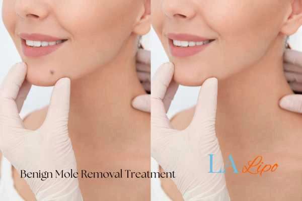 Before-and-after results following benign mole-removal treatment East Grinstead