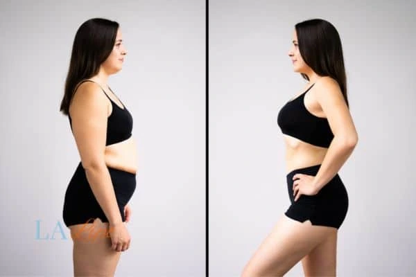 image of woman before and after results of LA-EMS Body Sculpting East Grinstead to help treat Diastasis recti
