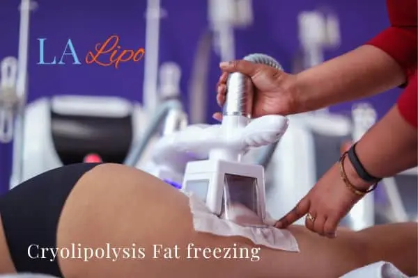 women getting fat freezing East Grinstead