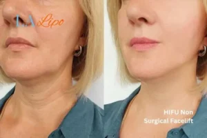 hi-fu for wrinkles East Grinstead before and after results