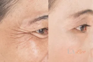 Before and after results of woman - HI-fu wrinkles reduction treatment East Grinstead