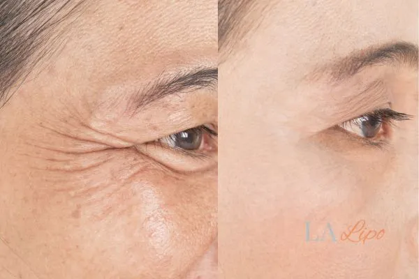 Before and after results of woman - HI-fu wrinkles reduction treatment East Grinstead