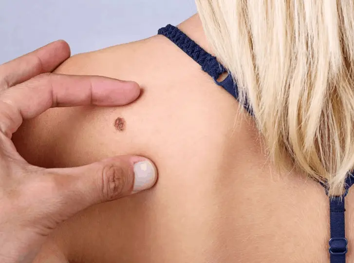 woman having mole removal East Grinstead consultation before treatment.