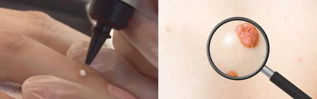 Cryopen for mole removal East Grinstead - speak to our team today!