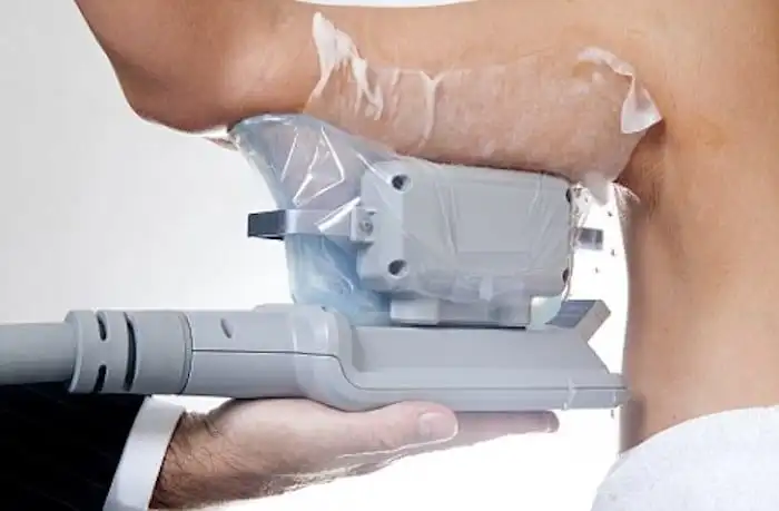 Picture of fat freezing East Grinstead on the upper arms.