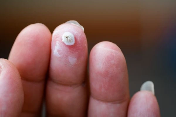 wart on person finger - cryotherapy to treat from LA LIPO East Grinstead