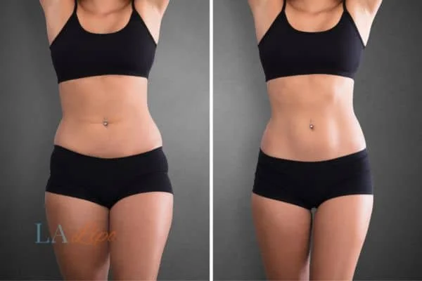 before and after results of non-surgical treatment to help a woman's body image and mental health East Grinstead
