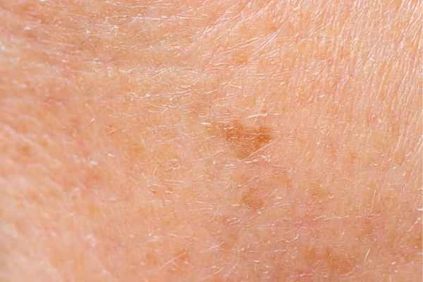 close up picture of age spots East Grinstead