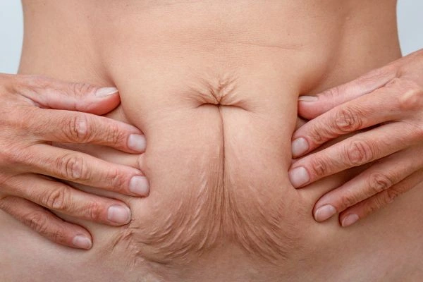 Should I Combine Diastasis Recti Treatment with Body Contouring for Better Results East Grinstead?