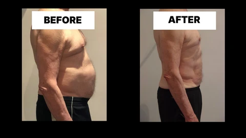 What Symptoms Can Diastasis Recti Cause in Men? Weak Core, Back Pain and Poor Posture East Grinstead